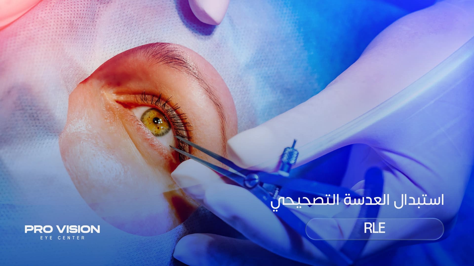 استبدال العدسة التصحيحي (RLE): دليلك الشامل لرؤية واضحة وحياة بدون نظارات